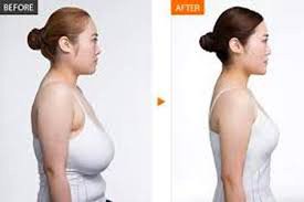 Insurance Cover Breast Lift