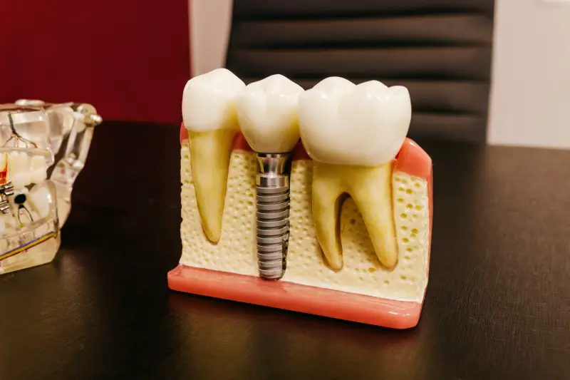 Dental Implants Cost Without Insurance